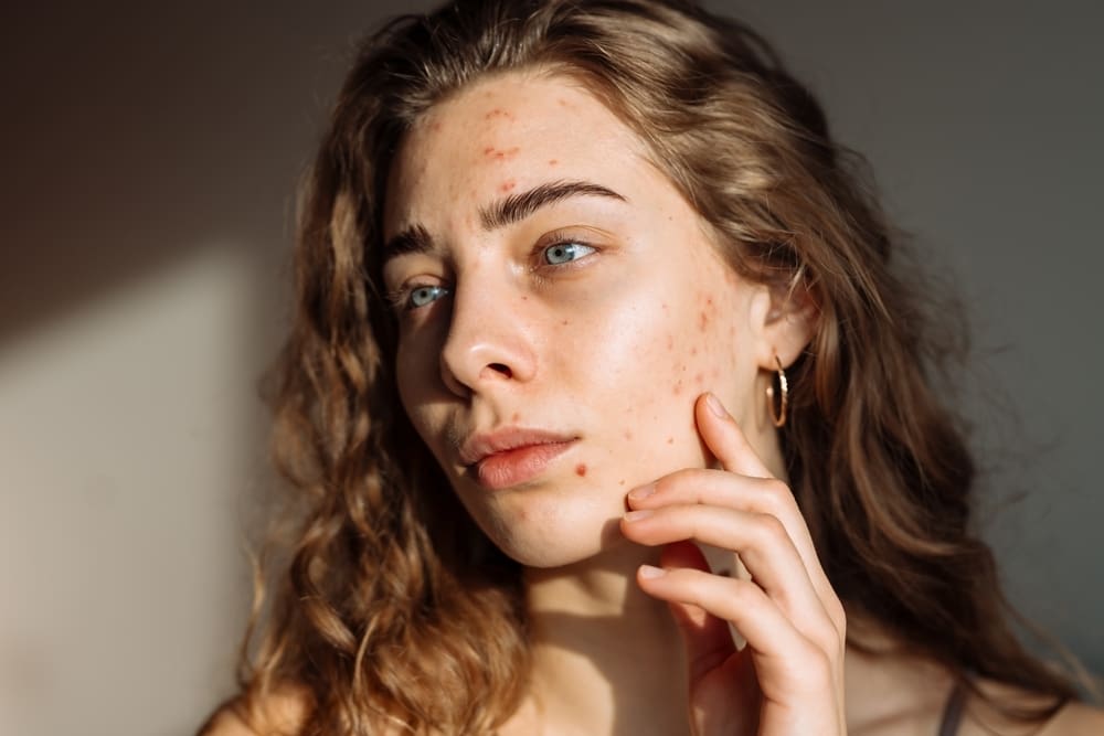 Woman suffering with acne breakouts